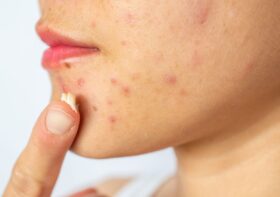 Is Your Acne Treatment Safe? A Look at the Recent Benzene Contamination Concerns